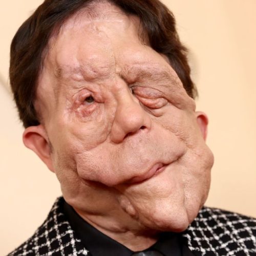 O que é neurofibromatose, condição que afeta o ator Adam Pearson
