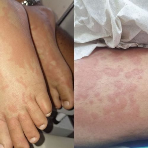 Suspeita de contaminação por detergente: saiba quadro de criança internada